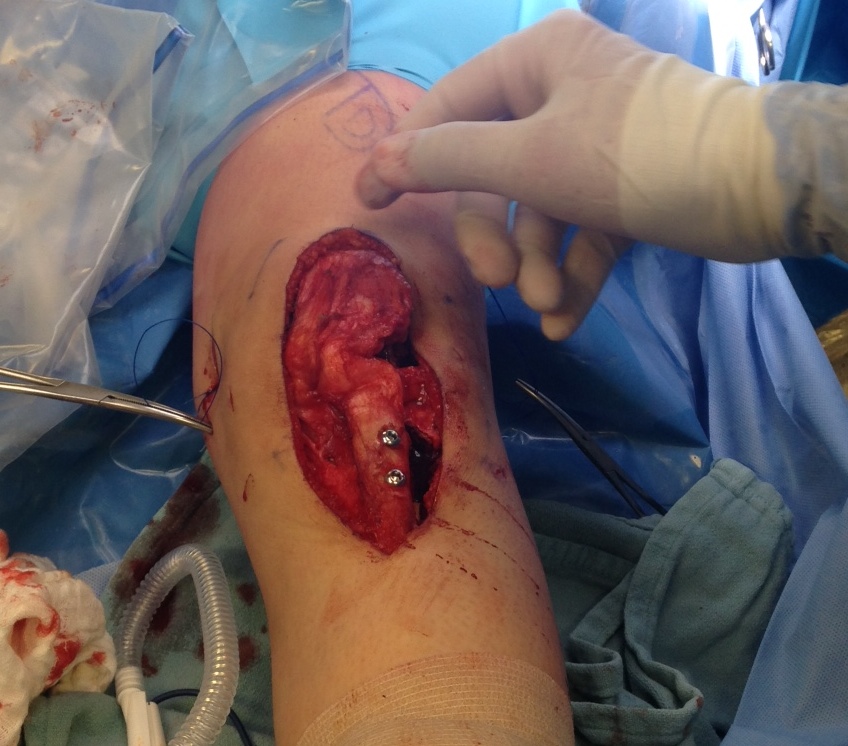 Tibial Tuberosity Transfer